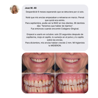 Colágeno Gingival